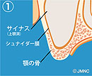 サイナスリフト1