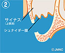 サイナスリフト2