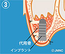 サイナスリフト3