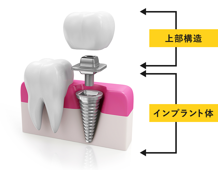 インプラント10年保証について