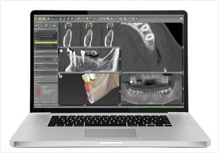診断・治療計画～インプラントシミュレーションソフト～