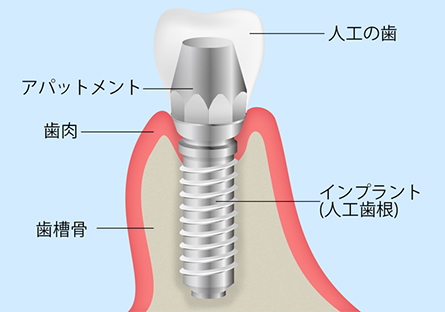 インプラントの構造