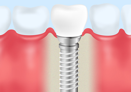 インプラント治療